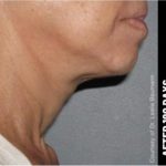 Ultherapy Before & After Patient #1555